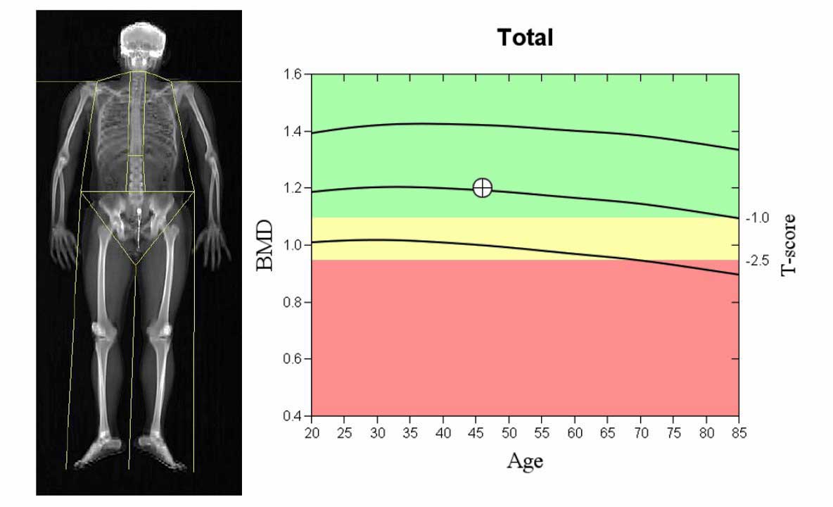 dexa scan in vijayawada