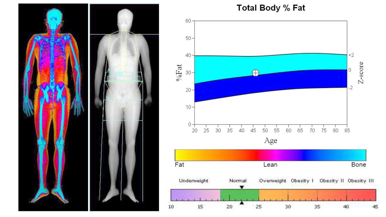 dexa scan in vijayawada